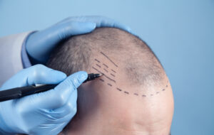  Hair transplant popularity